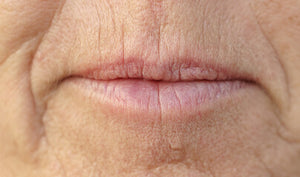 Fine Lip Lines